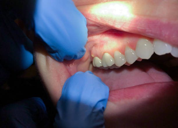 Best Emergency Treatment for Dental Infections or Abscesses in Palm Bay, FL